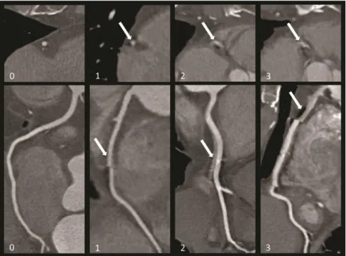 Figure 1. Examples of 4-point Likert scale of motion artifacts in heart transplant  recipients: 0, excellent image quality with no artifacts; 1, good image quality with 