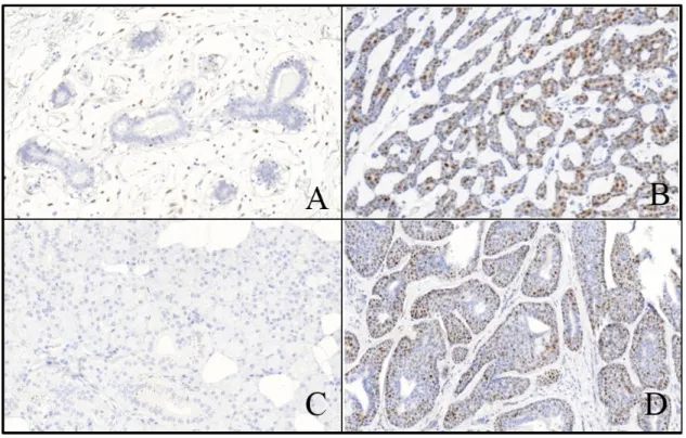 13. ábra. Cyclin D1 immunhisztokémiai reakció mikroszkópos képe normál emlőszövetben (A),  bACC esetében (B), normál nyálmirigy szövetben (C) és sACC esetében (D) (cyclin D1; 1:120; 