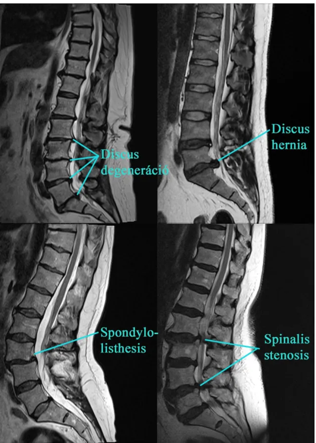 1. Ábra: Leggyakoribb biomechanikai jellegű gerincpatológiák MRI képe  (szagittális T2 szekvencia)  