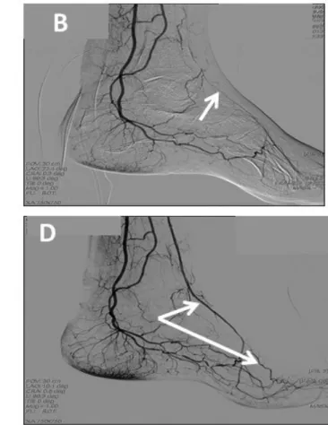 4. ábra Perifériás, térd alatti intervenció (Dr. Bánsághi Zoltán anyagából) A) Arteria tibialis anterior elzáródása (nyíl)