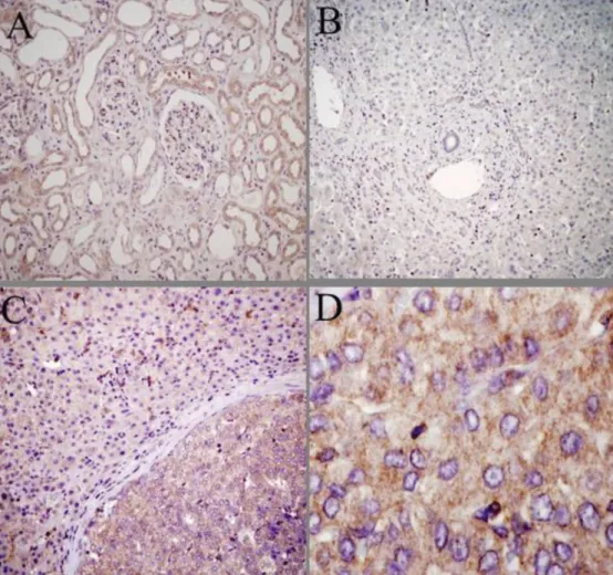 5. ábra CYP24A1 enzim expressziójának immunhisztokémiai kimutatása hepatocellularis carcinomában és a környező tumormentes májszövetben