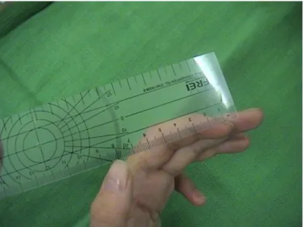 8. ábra – A hüvelyk-és mutatóujj nyitási távolságának mérése centiméter skálával  EDM-APB ínáthelyezés után 