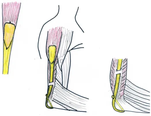 13. ábra – A módosított triceps rekonstrukció vázlatos rajza, baloldalon   a PD aponeurosisra helyezett tibialis anterior íngraft, side-to-side tovafutó, duplasoros 