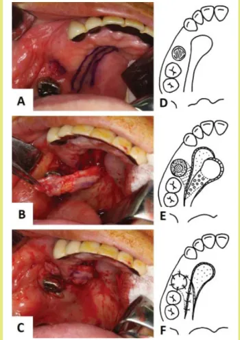 4. ábra: Az artéria palatinára nyelezett Pichler-lebeny - A, B, C klini- klini-kai fotó; D, E, F vázlatos ábra 17