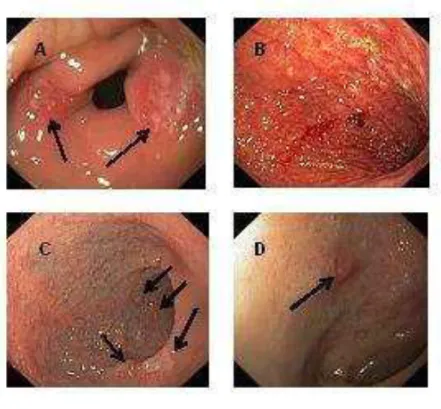 4. ábra  Oesophagogastroduodenoscopia során észlelt makroszkópos léziók Crohn- Crohn-betegségben