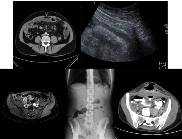 4. ábra. A Crohn-betegség jellegzetes képe képalkotó eljárásokkal (saját anyag) A  kép:  MR  vizsgálat:  vastagabb  falú  vékonybél  kacsok  láthatóak,  B  kép:  Hasi  ultrahang: vastagabb falú terminalis ileum, C kép: MR vizsgálat: megvastagodott  falú te
