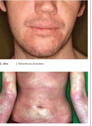 3. ábra Kiterjedt atopiás dermatitis