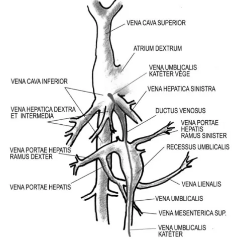 1. ábra. A katéter a vena umbilicalisból a ductus venosusba jutva éri el a vena cava inferiort
