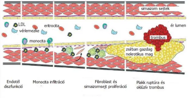 3. ábra: Az ateroszklerózis stádiumai.  
