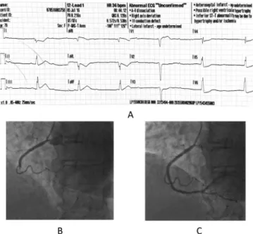 1. ábra III. fokú AV-blokkal szövődött inferior STEMI EKG- (A) és koronarográfiás képe PCI előtt (B) és után (C)