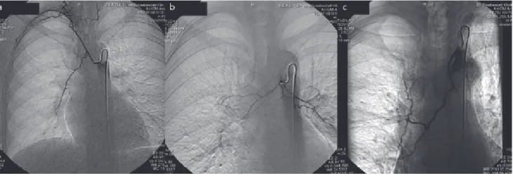 6. ábra a) Az arteria axillaris mellkasfali ága felől kialakult söntön keresztül telődik egy pulmonalis artéria