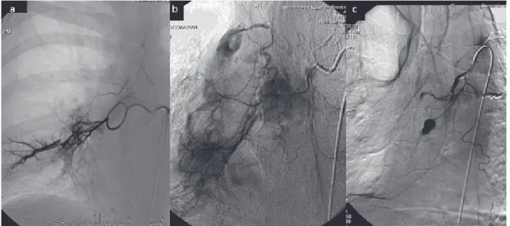 7. ábra a) A jobb arteria bronchialis festésekor intenzíven telődik egy pulmonalis artéria