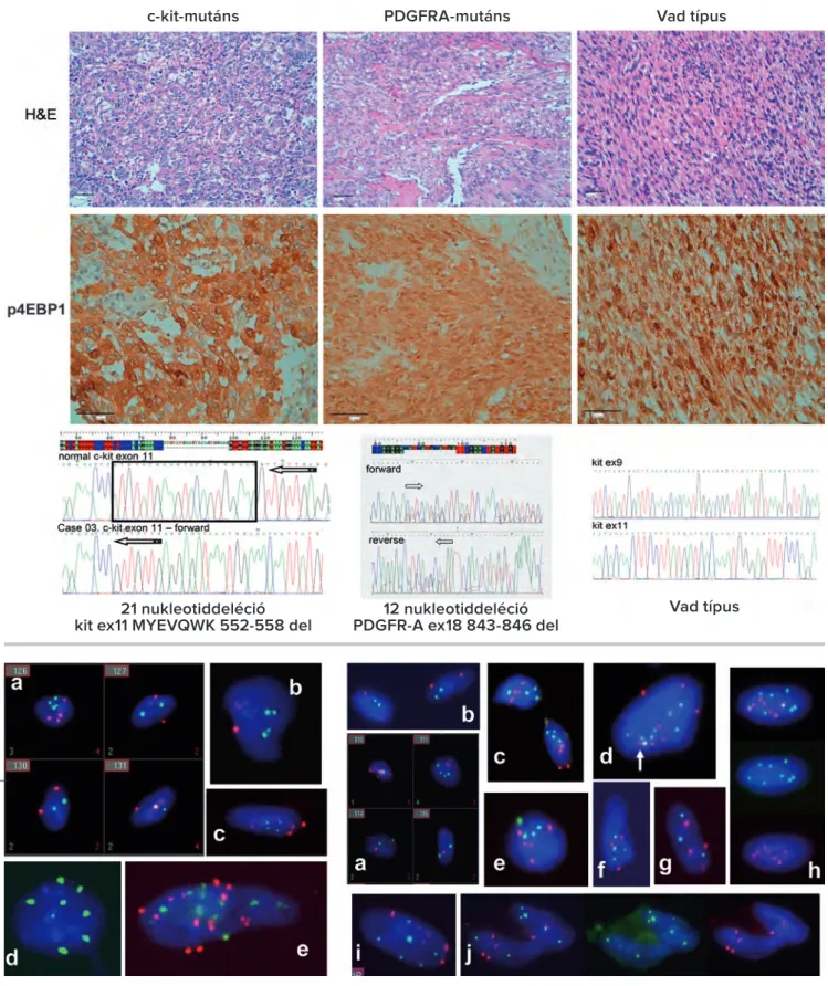 14. ábra. c-kit-mutáns, PDGFRA-mutáns és vad típusú gastro intestinalis stromalis tumor esetek reprezentatív hematoxilin-eozin  képe, p4EBP1 immunreakciója és szekvenogramja