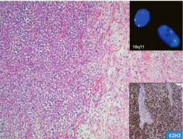 16. ábra. Gyengén differenciált synovialis sarcoma szöveti  képe erős magi EZH2-pozitivitással (jobb alsó inzert)