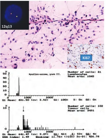 4. ábra. Epithelioid sarcoma jellegzetes szöveti képe, mely  carcinomaáttéttől a CD34-pozitivitás és az INI1-negativitás  (in-zertek) alapján különíthető el