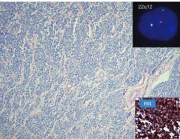 6. ábra. Jellegtelen myxoid tumor szöveti képe, a  derma to- to-fibrosarcoma protuberansra (DFSP) jellemző storiform  mintá-zat nem mutatkozik