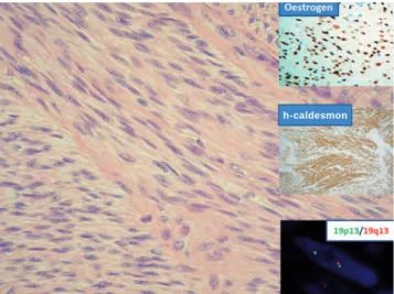 10. ábra. Pleiomorph lipoma (a) és atípusos lipomatosus tu- tu-mor (b) szinte teljesen ugyanolyan szöveti képe