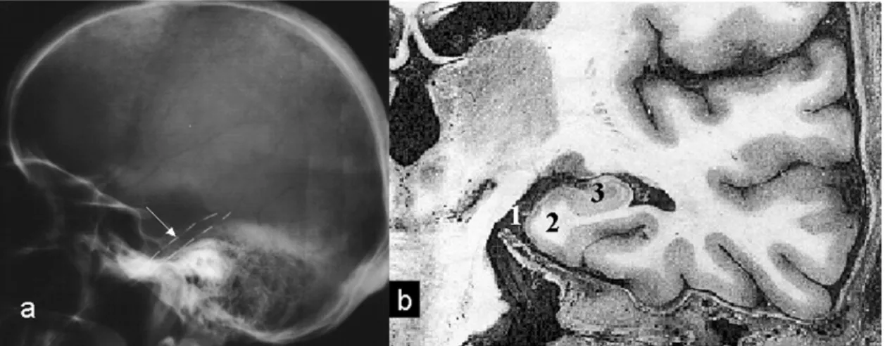 II.1. ábra. a) a foramen ovale elektródák beültetése után készült koponyaröntgen-felvétel; b) a foramen  ovale elektródákkal kapcsolatos anatómiai struktúrák: 1