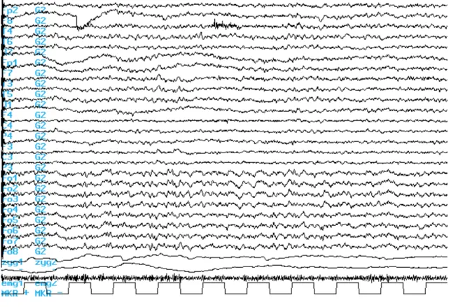 II.2. ábra. Az ébrenlét-nyitott szem EEG jellemzőinek szemléltetése a 10-20-as rendszer skalp  elektródáiban és a foramen ovale elektródákban egy 24 éves jobb temporális epilepsziás beteg esetében