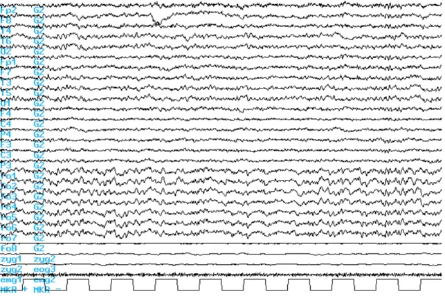 II.3. ábra. Az ébrenlét-csukott szem EEG jellemzőinek szemléltetése a 10-20-as rendszer skalp  elektródáiban és a foramen ovale elektródákban egy 24 éves jobb temporális epilepsziás beteg esetében