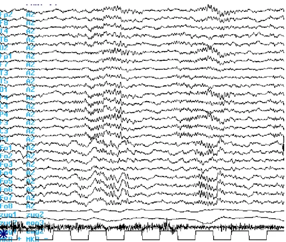 II.4. ábra. A felszínes NREM alvás EEG jellemzőinek szemléltetése a 10-20-as rendszer skalp  elektródáiban és a foramen ovale elektródákban egy 24 éves jobb temporális epilepsziás beteg esetében