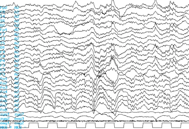 II.5. ábra. A mély NREM alvás EEG jellemzőinek szemléltetése a 10-20-as rendszer skalp elektródáiban  és a foramen ovale elektródákban egy 24 éves jobb temporális epilepsziás beteg esetében