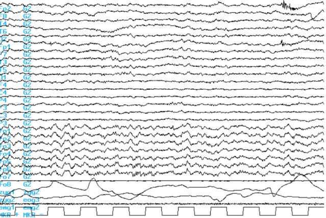 II.6. ábra. A REM alvás EEG jellemzőinek szemléltetése a 10-20-as rendszer skalp elektródáiban és a  foramen ovale elektródákban egy 24 éves jobb temporális epilepsziás beteg esetében