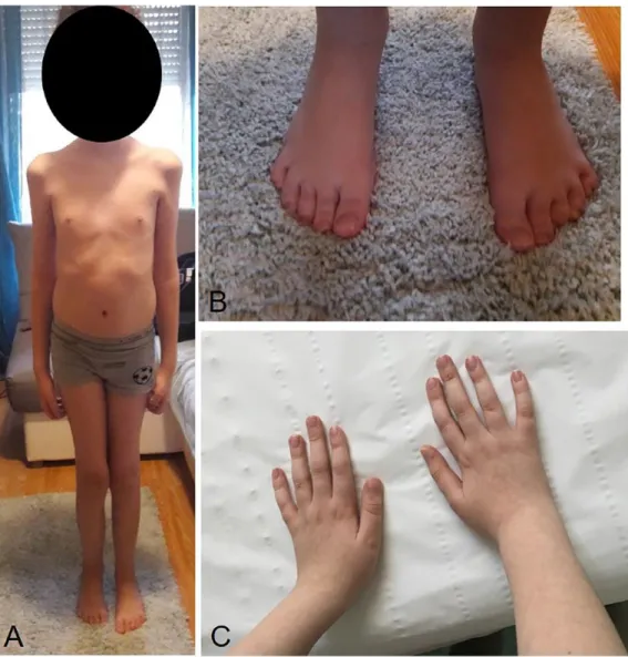 Figure 1.  The child, 12 years old, was thin and weak and presented flat feet and short fingers with weak  extensor indicis and carpi ulnaris muscles.