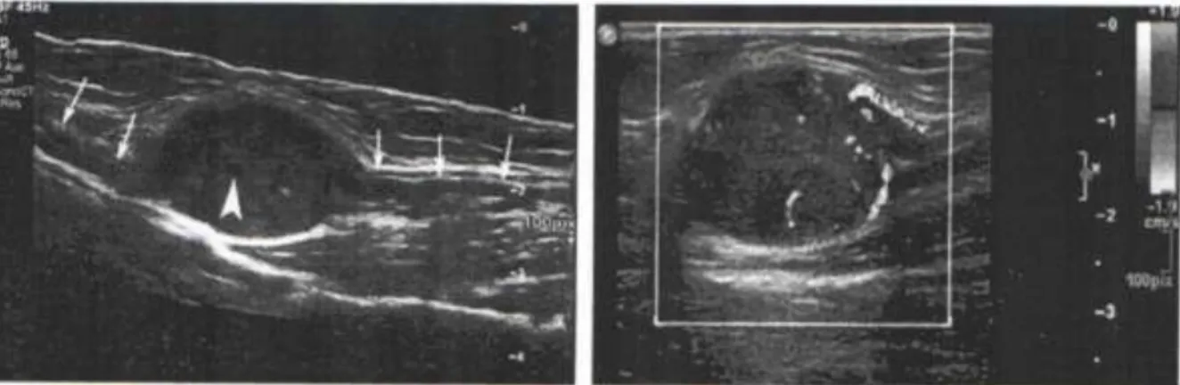 5. ábra. Schwannoma típusos képe. A baloldali ábrán a hosszmetszetben ábrázolt nervus  medianuson (nyílak) lévő, jól körülírt, echoszegény képlet látható, amelyben a kis nyíl 