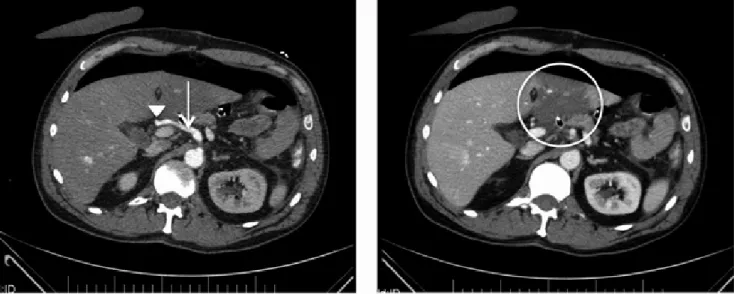 1. ábra CT-felvételek: a bal oldali angio-CT-felvételen látható a bal oldali arteria hepatica (nyíl) jelölt ponttól (nyílhegy) kezdődő telődéskiesése