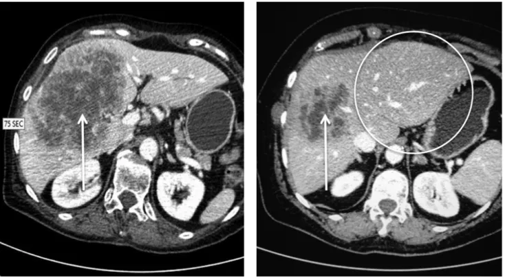 7. ábra CT-felvételek. Bal oldali kép: vena portae ligatúra előtt: a jobb lebeny csaknem egészét érintő inhomogén térfoglalás (nyíl)
