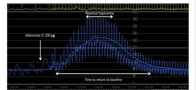 Figure 8 – Example of a typical Doppler velocity tracing. The figure illustrates,  how  the  various  measurements  have  been  performed  in  the  present  study