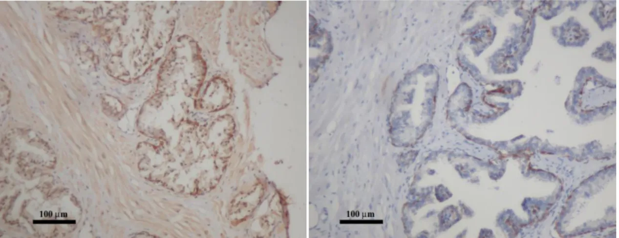13. Ábra A citokeratin 17 expressziója (bal oldali kép) és a citokeratin 19 (jobb oldali  kép) expressziója a perifériás zónában (DAB és hematoxilin háttérfestés, 100x 