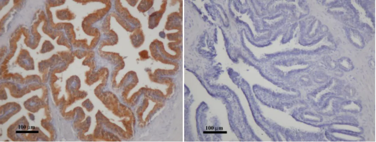 15. Ábra PSA expresszió a centrális zóna luminális sejtjeiben (bal oldali kép). A PSA  nem expresszálódik a vesicula seminalis sejtjeiben (jobb oldali kép; DAB + hematoxilin  háttérfestés, 100x nagyítás)