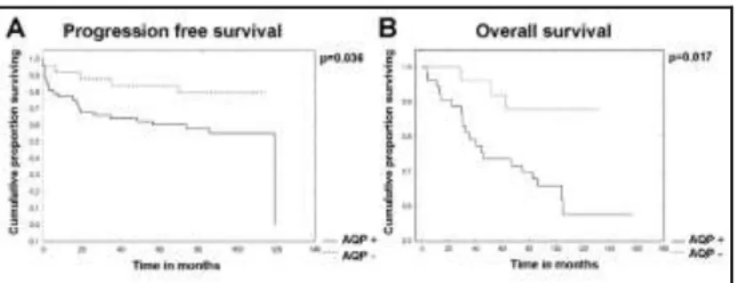 Figure 3.  Kaplan-Meier curves  showing  the comparison  of  progression  free  and  overall  survival  of  cutaneous  melanoma patients in case of anti-APQ1 positive (AQP+)  and  anti-AQP1  negative  (AQP-)  immunolabeling