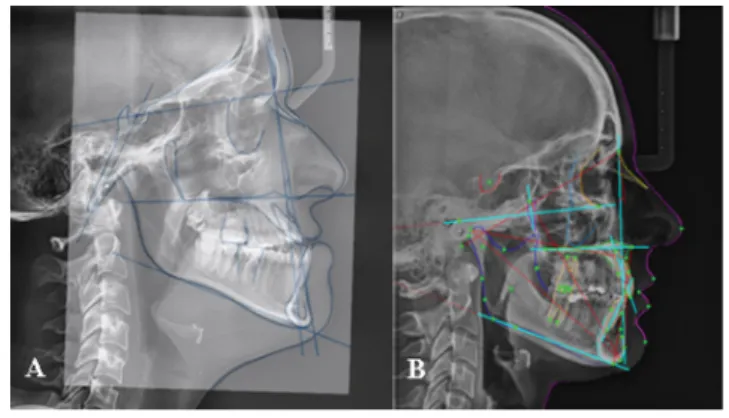 1. ábra A hagyományos analóg technikával készült röntgenfelvétel (A)  és a digitális röntgenkészülékkel létrehozott röntgenképen (B)  végzett cefalometriai mérések