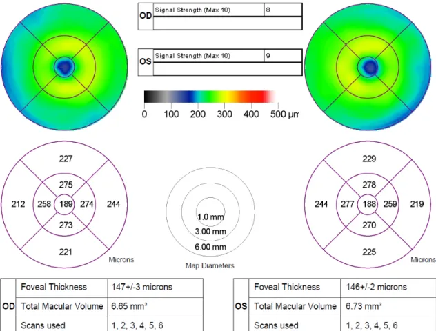2. ábra. Egészséges macula OCT képe (Stratus OCT, 6 mm-es leképezési hossz), a vastag fehér  vonalak a retinának a Stratus OCT szoftvere által kijelölt belső és külső határvonalát jelölik