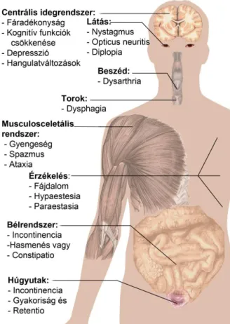 11. ábra A sclerosis multiplex tünetei.  189