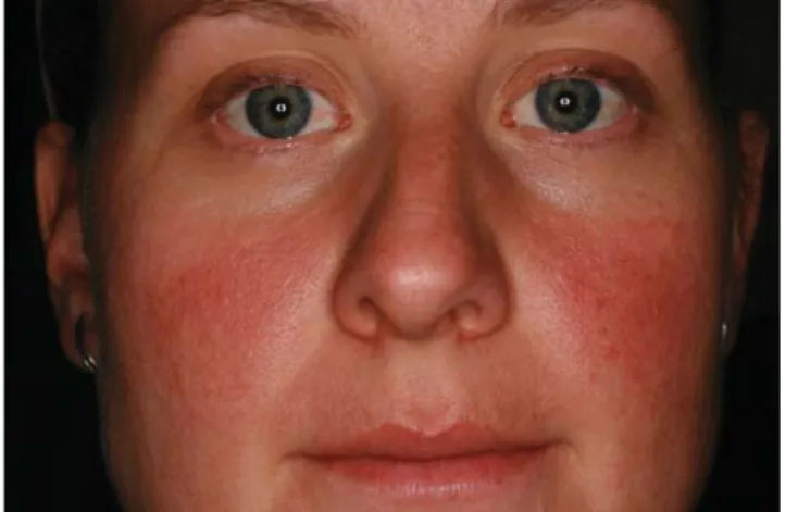 1. ábra Erythemás-teleangiectasiás rosacea: perzisztáló erythema az arc  középső részén