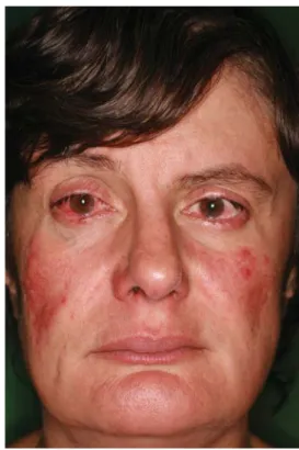 6. ábra Rosacea fulminans: hirtelen kialakult gyulladt papulák, számos  pustula 