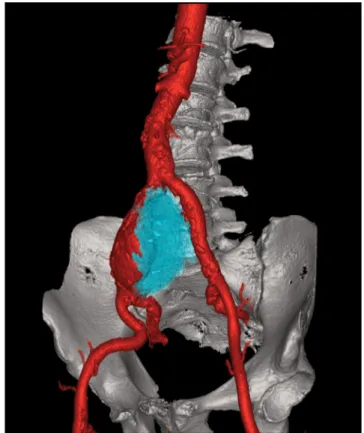 1. ábra A. iliaca communis izolált aneurysma CTA-rekonstrukciós képe. 