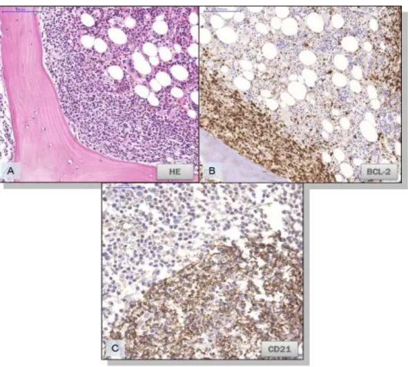 9. Ábra. Csontvelői érintettség follicularis lymphomában. 