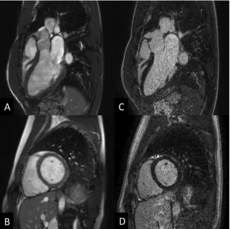 Figure 2: Cardiac magnetic resonance images of an athlete: cine balanced steady-state  free precession (bSSFP) images (A,B) and late gadolinium enhancement images (C, D)  in long- and short-axis views
