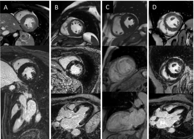 Figure 4: Cine bSSFP and late gadolinium enhancement images of HCM and HCM  phenocopies:  aortic  stenosis  (A),  HCM  (B),  amyloidosis  (C),  Anderson-Fabry  disease (D)