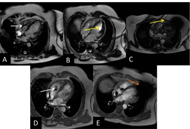 3. ábra: bSSFP (A-C) és SGE felvételek (D,E) 6 hónappal a CRT implantációt követően. A  CRT-P eszközök esetén a bSSFP felvételeken a generátor okozta műtermék (sárga nyíl) nem  érinti a szívet (A), az elektróda okozta műtermék (narancssárga nyíl) nem zavar