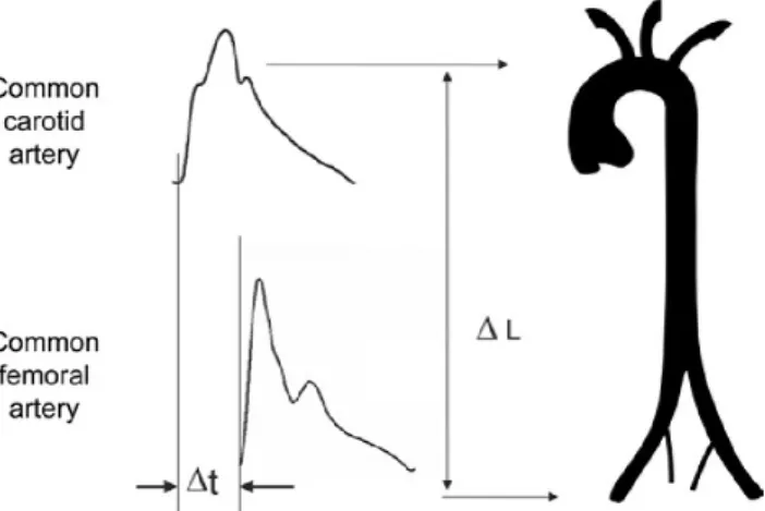 Figure 3. Measurement of carotid-femoral PWV  with the foot-to-foot method. 
