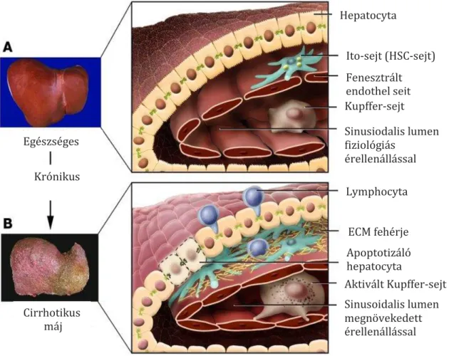 1. ábra. A máj fibrosisa során bekövetkező makro- és mikroszkópos elváltozások. 