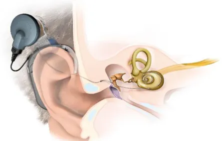 6. ábra: A cochlearis implantátum felépítése.  