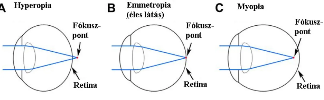 4. ábra: Hyperopia, emmetropia, myopia 