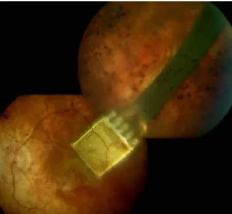 3. ábra. A szubretinális implantátum a beültetést követően a szemfenéken. Az ábrán jól  látható a macula területében a direkt stimulációs elektródák, valamint a maculán kívül a  chip és a tápkábel